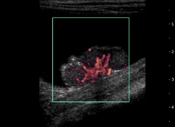 Ultrasound depicting a bladder lesion.